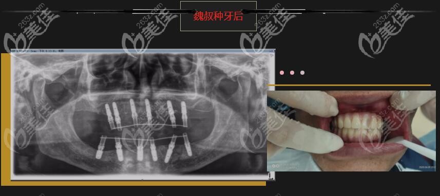 魏叔做allon6全口種植牙 魏叔做allon6全口種植牙