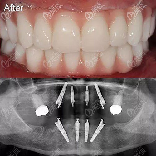 Allon4半口種植修復(fù)效果圖 Allon4半口種植修復(fù)效果圖