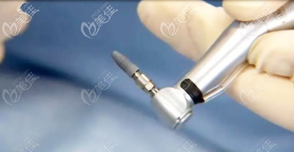 種植體外觀展示圖 種植體外觀展示圖