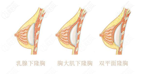 隆胸假體放在哪個(gè)層次手感更好一些