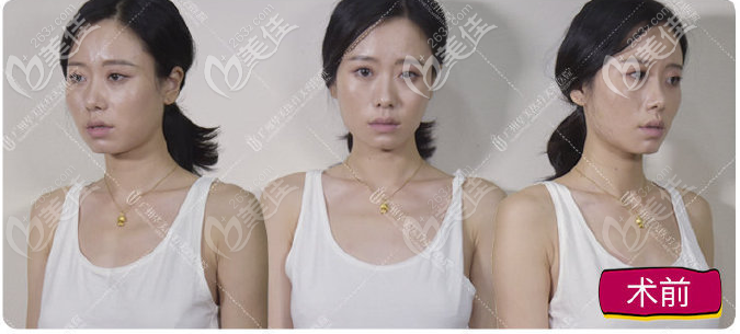 廣州華美醫(yī)療美容整形醫(yī)院郝永生術(shù)前照片1