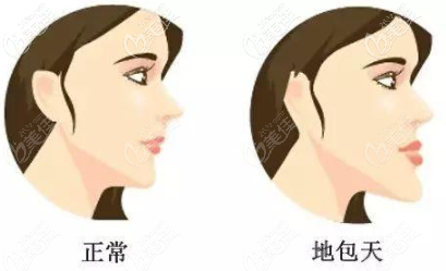 單純下巴突出的地包天
