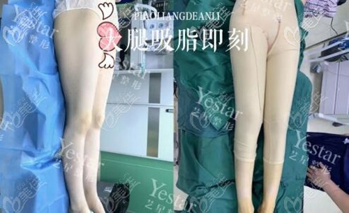 昆明藝星整形大腿吸脂術(shù)后即刻效果