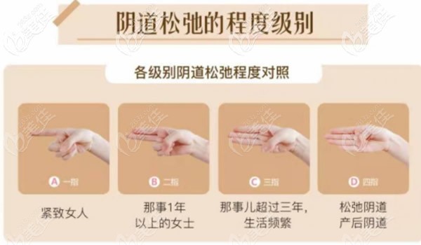 陰道松弛程度級別 陰道松弛程度級別