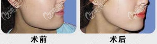 穆雄錚下頜角手術(shù)案例