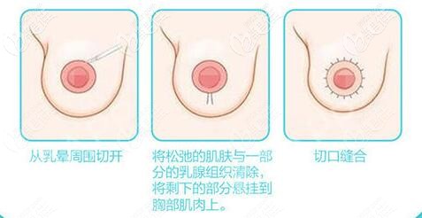 乳房雙環(huán)懸吊提升手術(shù)步驟