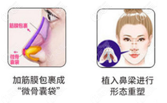 軟糖半肋軟骨真空隆鼻其實是用筋膜包裹的