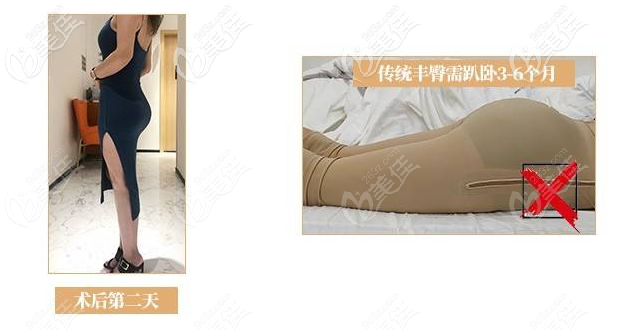 深圳曹孟君豐臀技術怎么樣 深圳曹孟君豐臀技術怎么樣