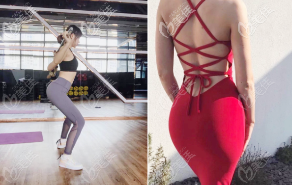 深圳曹孟君假體豐臀實例療效圖 深圳曹孟君假體豐臀實例療效圖