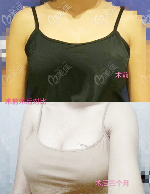 北京<!--<i data=20240703-sp></i>--><!--<i data=20240703-sp></i>-->隆胸圖片