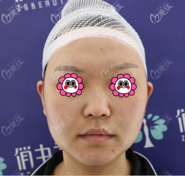 在北京俏中關(guān)醫(yī)美做鼻子前 在北京俏中關(guān)醫(yī)美做鼻子前