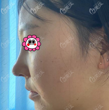 找薛軼群做鼻子有10幾天了 找薛軼群做鼻子有10幾天了