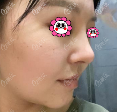 我做肋骨鼻綜合1個(gè)多月效果 我做肋骨鼻綜合1個(gè)多月效果