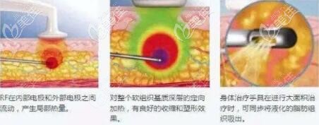 黃金微雕吸脂過程示意圖 黃金微雕吸脂過程示意圖