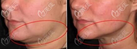 面部黃金微雕吸脂前后效果對比照 面部黃金微雕吸脂前后效果對比照