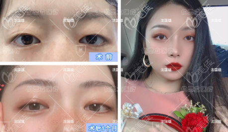 沈國雄全切雙眼皮+雙側提肌矯正效果圖