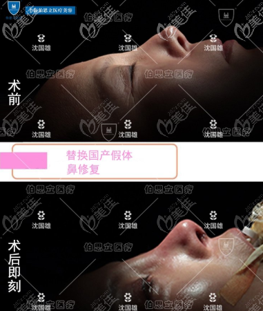 百達麗&伯思立整形沈國雄攣縮鼻凹陷修復效果圖