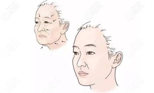 面部除皺方法 面部除皺方法