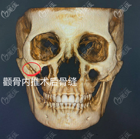 顴骨內(nèi)推術(shù)后三維ct拍攝骨縫