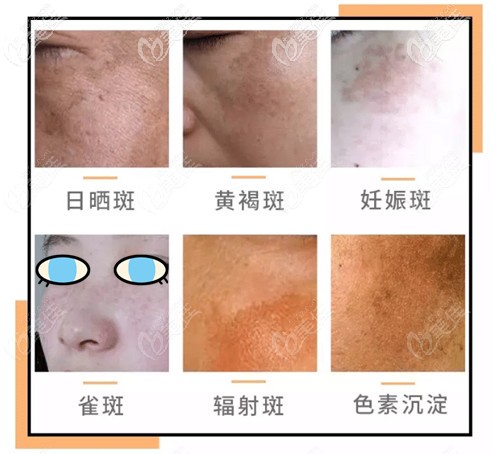 陳珊醫(yī)生擅長(zhǎng)治療各種斑點(diǎn) 陳珊醫(yī)生擅長(zhǎng)治療各種斑點(diǎn)