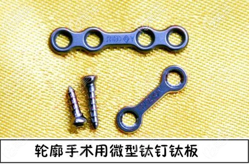 顴骨內(nèi)推使用的鈦釘鈦板固定材料