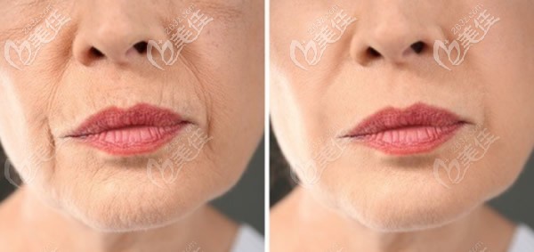 面部小切口提升前后對比照片