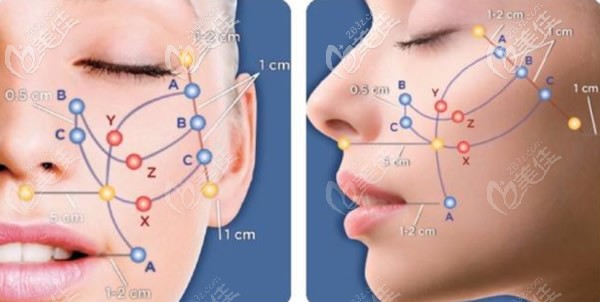 埋線提升網(wǎng)狀布線圖