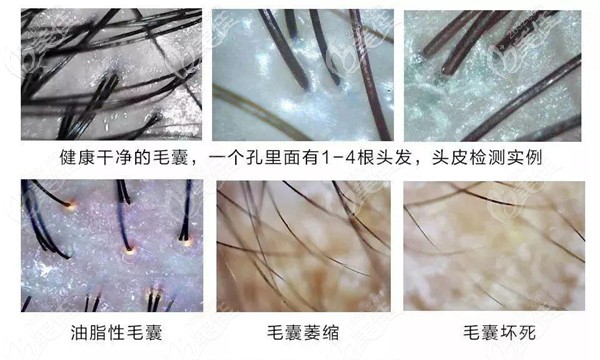 毛囊檢測為什么脫發(fā)都建議去做“毛囊檢測”