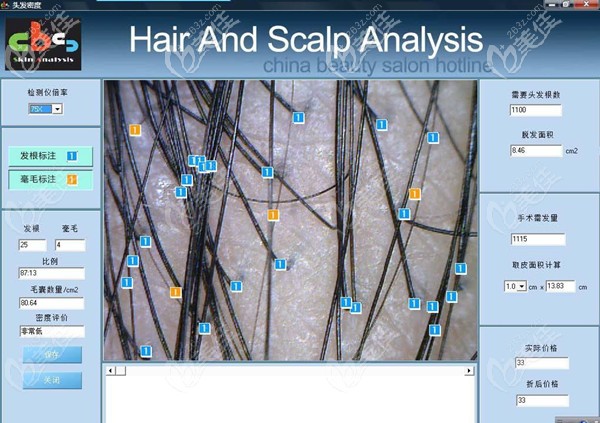 毛囊檢測能夠提供的數(shù)據(jù)分析