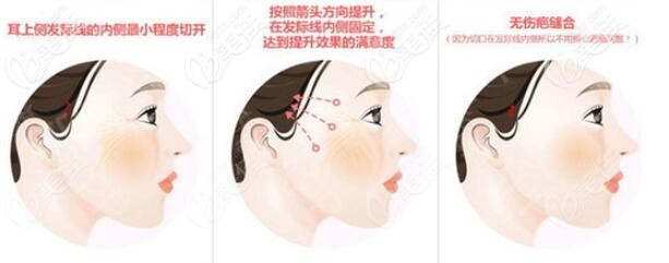 日式迷你小拉皮手術(shù)操作過程示意圖 日式迷你小拉皮手術(shù)操作過程示意圖