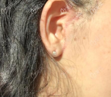 小切口拉皮手術(shù)恢復(fù)25天疤痕圖片 小切口拉皮手術(shù)恢復(fù)25天疤痕圖片