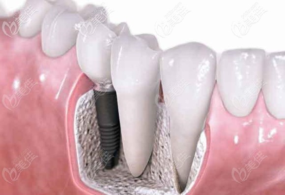 于洪海醫(yī)生擅長牙齒種植技術(shù)