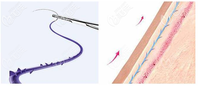 中山曙光張玲玉醫(yī)生擅長(zhǎng)埋線提升 中山曙光張玲玉醫(yī)生擅長(zhǎng)埋線提升