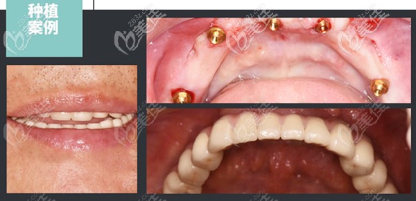 我在珠海香洲區(qū)諾貝爾牙科種植下半口牙齒的全過(guò)程