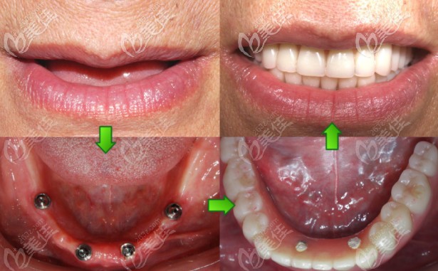 全口Allon4即刻種植