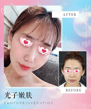 薈光子嫩膚真人前后對比照