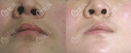 唇裂鼻畸形修復(fù)成功圖片 唇裂鼻畸形修復(fù)成功圖片