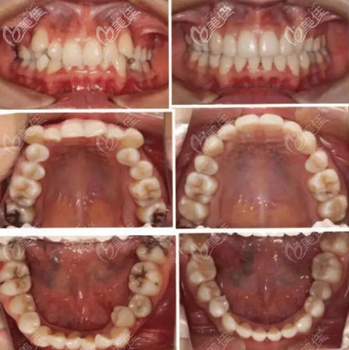 深覆合矯正前后對比