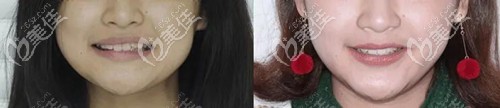 深覆蓋矯正臉型變化圖