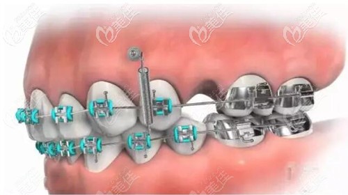通過種植釘壓低上前牙