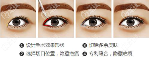 福州名韓雙眼皮手術(shù)過程