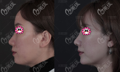 馮雁平鼻綜合案例效果參考