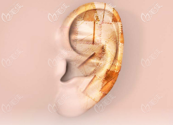 余文林醫(yī)生耳再造