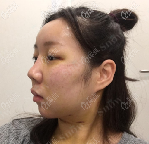 韓國snow面部吸脂+填充案例術后第六天
