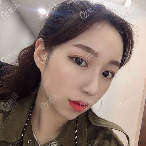 韓國snow面部吸脂+填充案例術后一個月