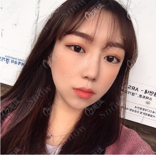 韓國snow面部吸脂+填充案例術后兩個月