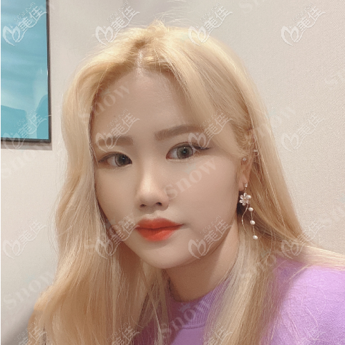 韓國snow面部吸脂真人案例術前照 韓國snow面部吸脂真人案例術前照