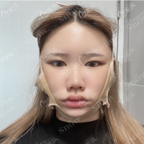 韓國snow面部吸脂真人案例術后第七天 韓國snow面部吸脂真人案例術后第七天