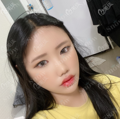 韓國snow面部吸脂真人案例術后兩個月 韓國snow面部吸脂真人案例術后兩個月