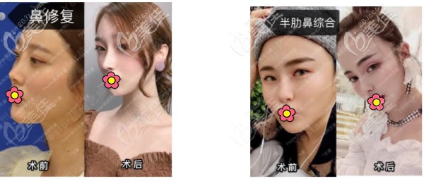杭州張龍醫(yī)生鼻修復和半肋骨綜合隆鼻案例